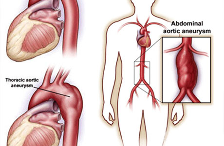 Aortic aneurysm